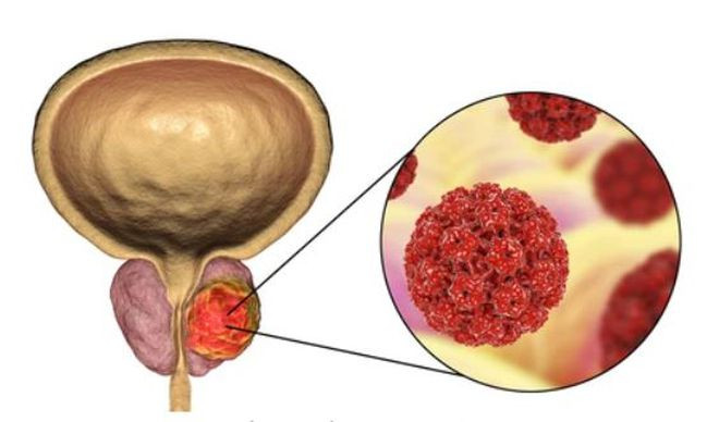 Mặc dù không phổ biến, nhưng ung thư tuyến tiền liệt có thể di căn đến ruột - Ảnh minh họa: Shutterstock Mặc dù không phổ biến, nhưng ung thư tuyến tiền liệt có thể di căn đến ruột - Ảnh minh họa: Shutterstock