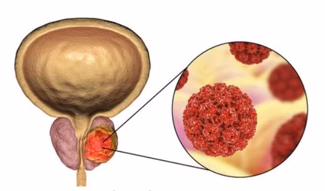 Mặc dù không phổ biến, nhưng ung thư tuyến tiền liệt có thể di căn đến ruột - Ảnh minh họa: Shutterstock