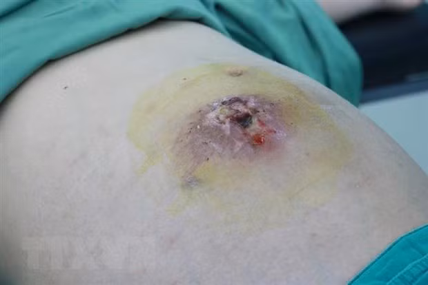 Bệnh nhân bị hoại tử vùng bụng do phòng khám tư nhân điều trị u xơ tử xung phản khoa học. (Ảnh: TTXVN phát) Bệnh nhân bị hoại tử vùng bụng do phòng khám tư nhân điều trị u xơ tử xung phản khoa học. (Ảnh: TTXVN phát)