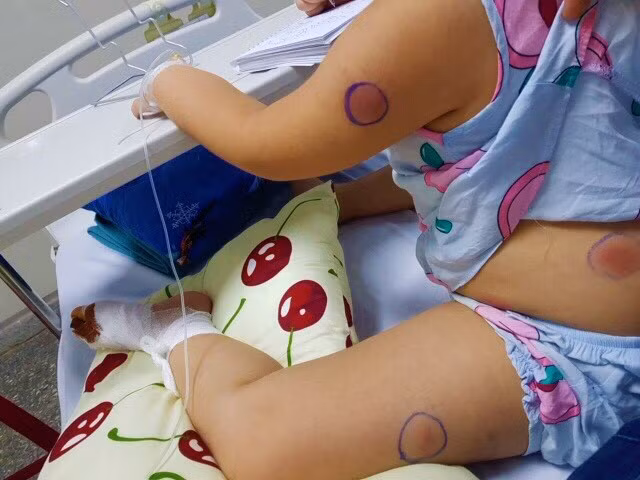 Cháu P với những vết sưng tấy có mầm mống của vi khuẩn Burkholderia pseudomalei trên cơ thể (ảnh do bệnh viện cung cấp). Cháu P với những vết sưng tấy có mầm mống của vi khuẩn Burkholderia pseudomalei trên cơ thể (ảnh do bệnh viện cung cấp).