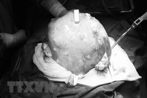 Khối u xơ tử cung nặng 2,6kg được các bác sỹ Bệnh viện Đại học Y dược Thành phố Hồ Chí Minh lấy ra khỏi ổ bụng bệnh nhân. (Ảnh: TTXVN phát)