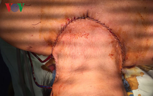 Sức khỏe của bệnh nhân đã ổn định.