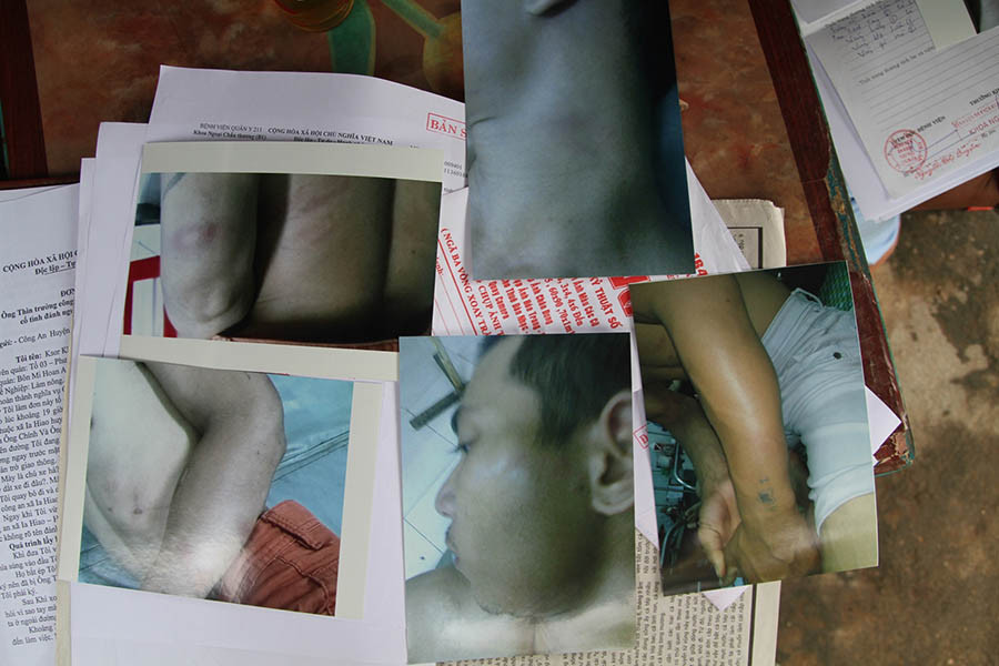  Các vết thương của anh Khoa sau khi bị đánh. Ảnh: V.N