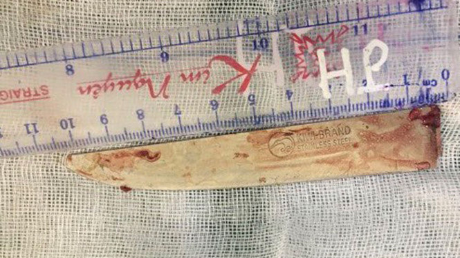 Con dao trong ngực bệnh nhân