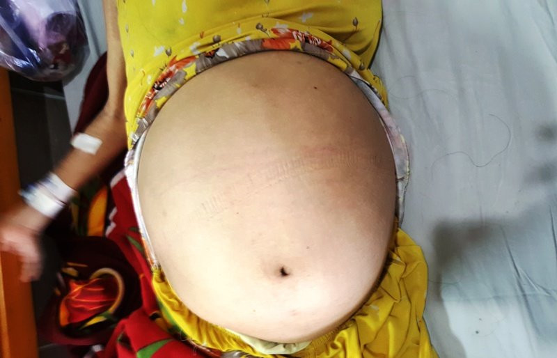 Khối u khổng lồ khiến bụng người phụ nữ như mang bầu