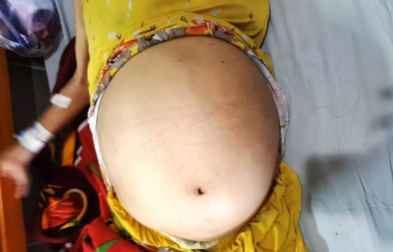 Khối u khổng lồ khiến bụng người phụ nữ như mang bầu