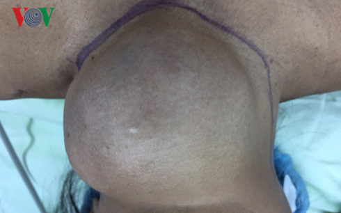 Khối u của bệnh nhân.