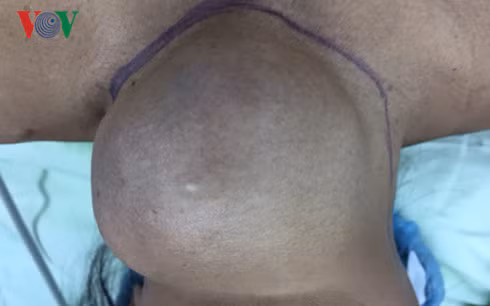 Khối u của bệnh nhân.