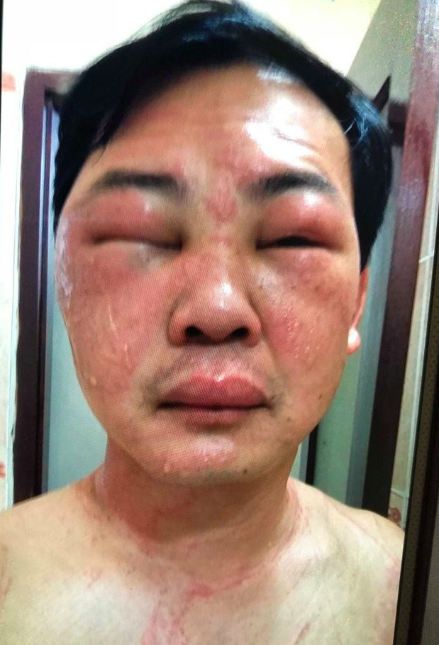 Khuôn mặt bệnh nhân sưng vù sau ít phút bị sứa đốt. Khuôn mặt bệnh nhân sưng vù sau ít phút bị sứa đốt.