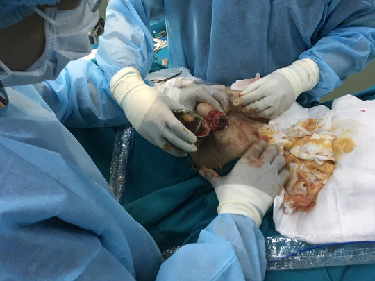 Các bác sĩ phẫu thuật cho nữ bệnh nhân