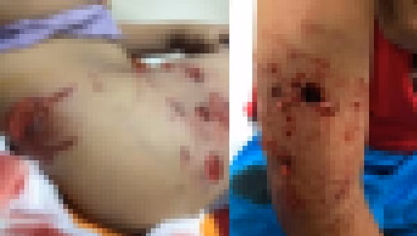 Hình ảnh vết cắn bé trai 4 tuổi (trái) và vết thương sâu đến tận xương trên cánh tay bé 10 tuổi