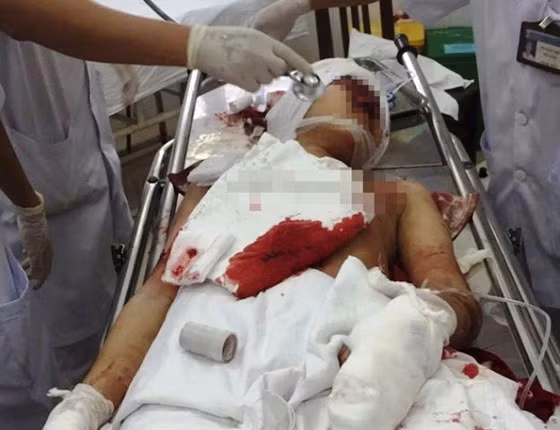  Cháu N. bị thương tích nặng sau khi bị ông Bình dùng dao chém