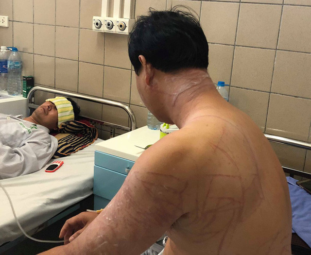 Toàn bộ vùng cổ, lưng bệnh nhân chằng chịt vết đốt do sứa cuốn vào. Toàn bộ vùng cổ, lưng bệnh nhân chằng chịt vết đốt do sứa cuốn vào.