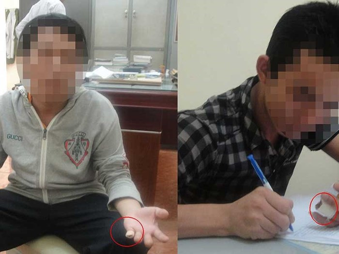 Hai nạn nhân bị chặt ngón tay vì nợ tiền ở casino.