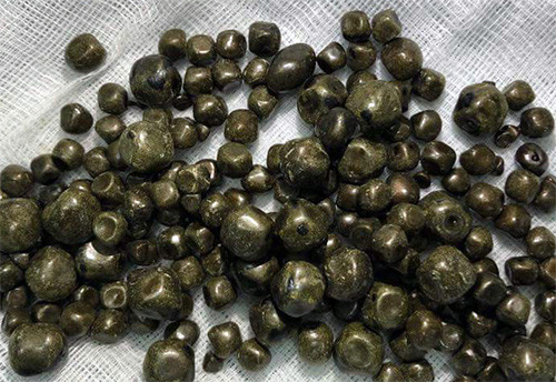 Hàng trăm viên sỏi được lấy ra từ túi mật bệnh nhân. Ảnh: Bệnh viện cung cấp