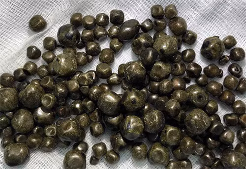 Hàng trăm viên sỏi được lấy ra từ túi mật bệnh nhân. Ảnh: Bệnh viện cung cấp