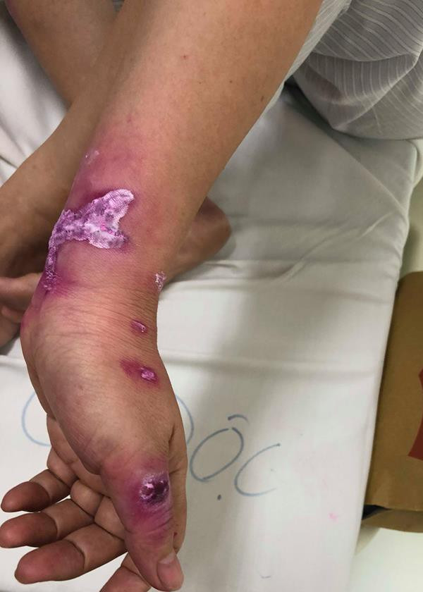 Bệnh nhân bị tổn thương sâu, hiện đang có nhiễm trùng do dùng chanh chà sát mạnh vào vùng bị sứa đốt. Bệnh nhân bị tổn thương sâu, hiện đang có nhiễm trùng do dùng chanh chà sát mạnh vào vùng bị sứa đốt.