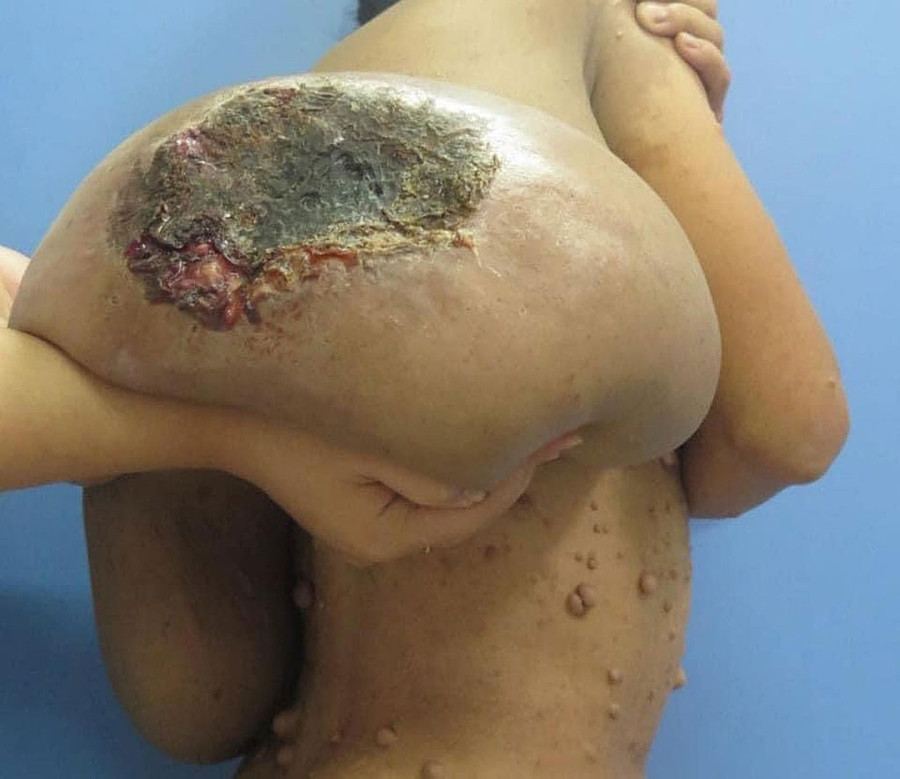 Một bệnh nhân bị chẩn đoán u sợi thần kinh ngoại biên khổng lồ ở vùng lưng được ê kíp của GS-BS Trần Thiết Sơn phẫu thuật. 10 ngày sau đã được ra viện. ẢNH: FACEBOOK BÁC SĨ TRẦN THIẾT SƠN