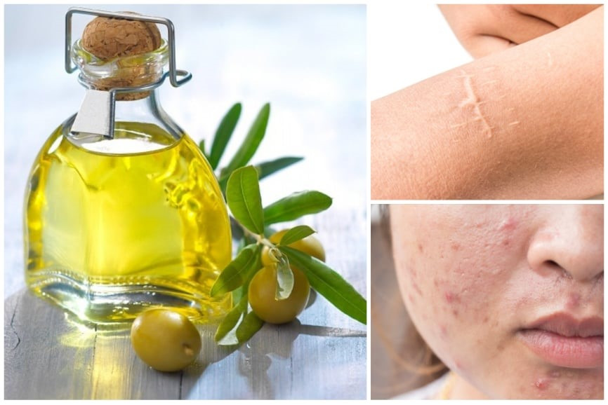 Công dụng của dầu mù u rất đa dạng, hỗ trợ trị mụn, chăm sóc tóc, kích thích vết bỏng mau lành cũng như nhiều lợi ích khác. Đồ hoạ: Minh Đức