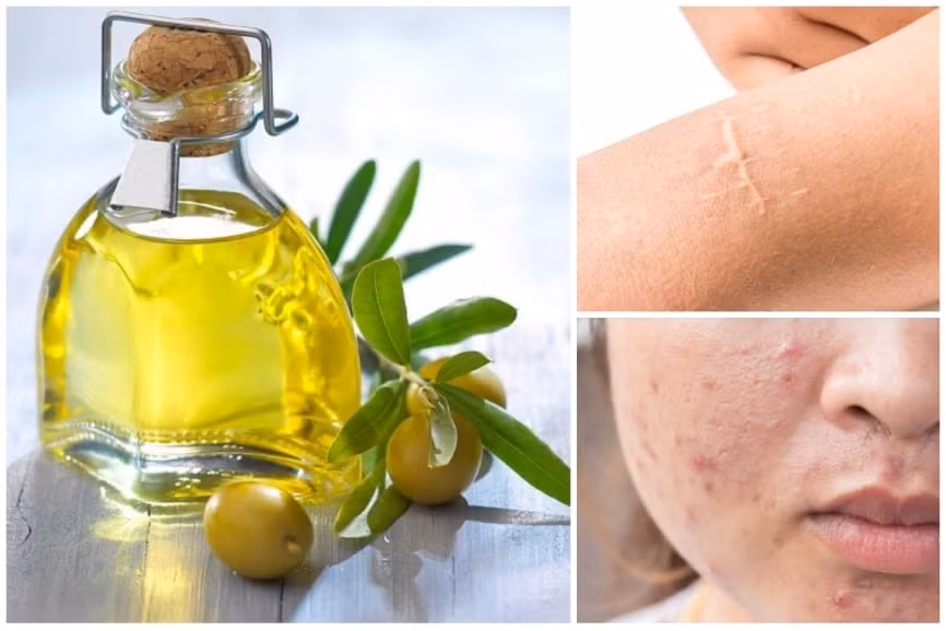 Công dụng của dầu mù u rất đa dạng, hỗ trợ trị mụn, chăm sóc tóc, kích thích vết bỏng mau lành cũng như nhiều lợi ích khác. Đồ hoạ: Minh Đức