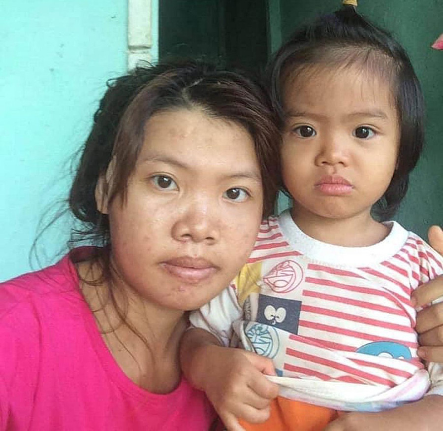 Quách Thị Phượng trước khi phẫu thuật. ẢNH: NVCC