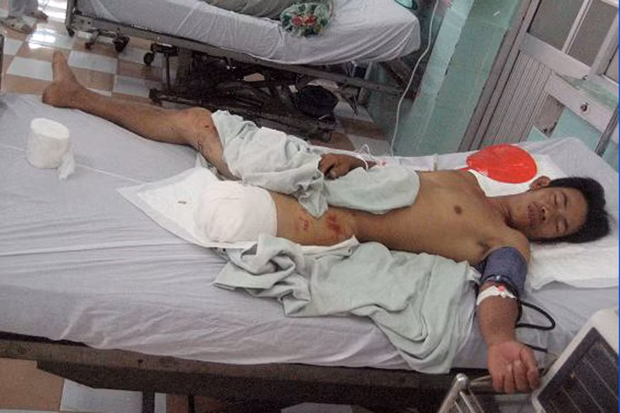 Anh Duy bị cắt bỏ chân trái đến gối và đang nằm theo dõi tại Khoa hồi sức cấp cứu ngoại, Bệnh viện đa khoa tỉnh Bình Định.