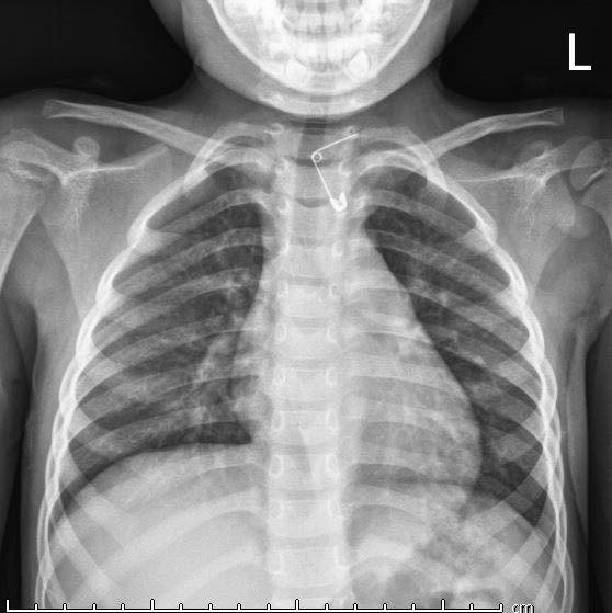 Vị trí chiếc kim băng nằm trong thực quản bệnh nhi.