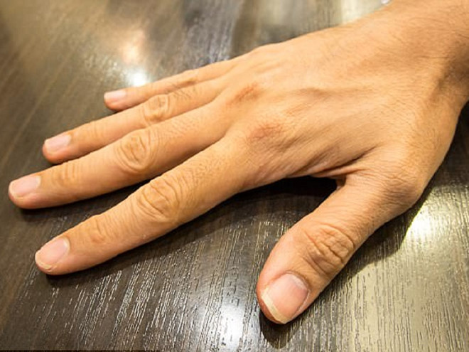Đôi tay ghép là của đàn ông, da có màu sậm đen đã chuyển sang trắng sáng khi ghép vào tay cô Shreya/ Ảnh minh họa: Shutterstock Đôi tay ghép là của đàn ông, da có màu sậm đen đã chuyển sang trắng sáng khi ghép vào tay cô Shreya/ Ảnh minh họa: Shutterstock