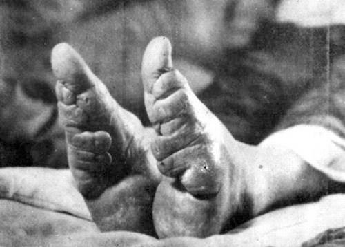 Đôi bàn chân dị dạng vì hủ tục bó chân. Đôi bàn chân dị dạng vì hủ tục bó chân.