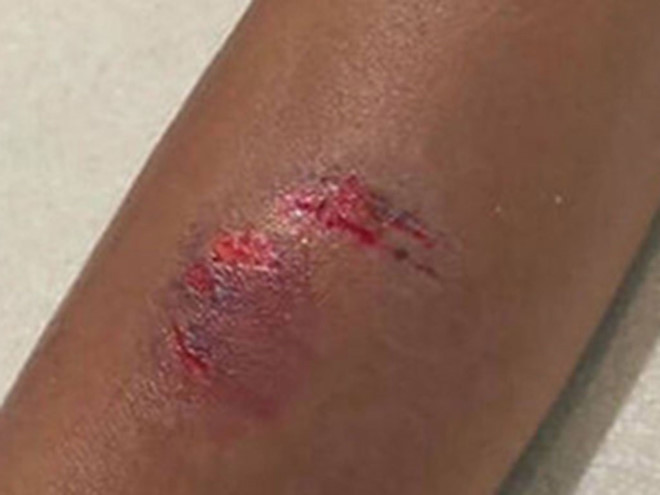 Vết thương trên tay nhân viên hàng không sau khi bị nữ hành khách cắn