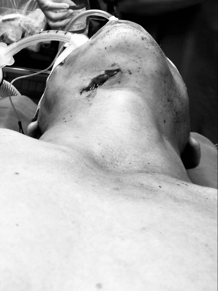 Vị trí vết thương vùng cổ Vị trí vết thương vùng cổ