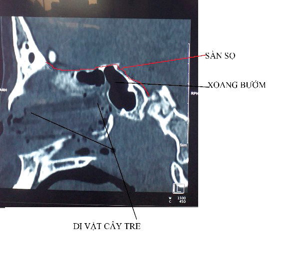 Hình ảnh cho thấy dị vật đâm sát và sàn sọ và xoang bướm cực kỳ nguy hiểm/ Ảnh: Đình Tuyển Hình ảnh cho thấy dị vật đâm sát và sàn sọ và xoang bướm cực kỳ nguy hiểm/ Ảnh: Đình Tuyển