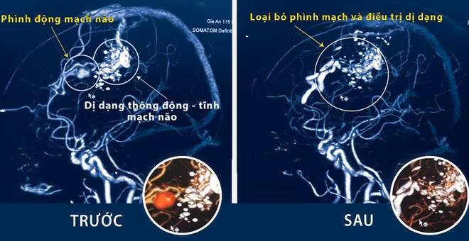 Hình ảnh CT Scan mạch máu não cho thấy bệnh nhân bị xuất huyết màng não số lượng nhiều ẢNH: BVCC