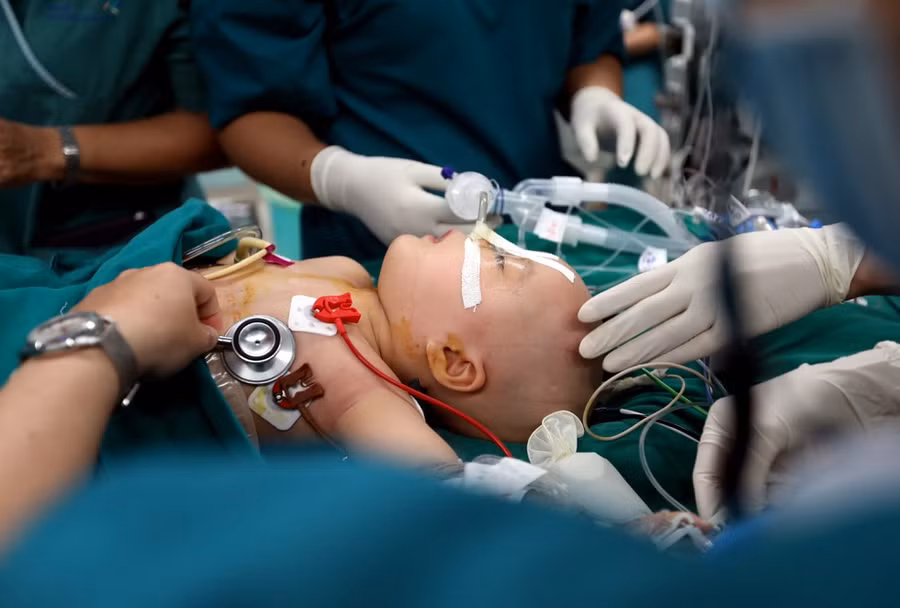 Bác sĩ Trương Quang Định cho biết, thời điểm mấu chốt nhất của cuộc mổ là khi kẹp mạch máu, mổ tách hai bé ra vì hai bé sống chung “cộng sinh” với nhau đã 1 năm qua, mọi tác động đến bé này thì đều ảnh hưởng đến bé kia. Hai bé đã 13 tháng, xương đã bắt đầu cứng nên việc mổ tách xương khá khó khăn ẢNH: NGỌC DƯƠNG