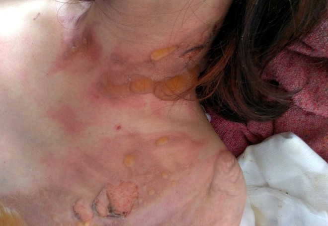 Nguyễn Thị Thùy Dung tự đổ cồn lên người phóng hỏa khiến mình bị bỏng nặng