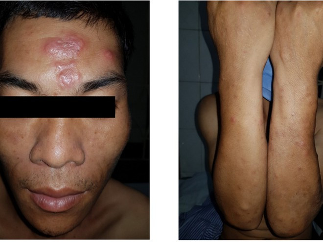 Bệnh nhân phong với các tổn thương trên bề mặt da. Ảnh: THU HƯƠNG
