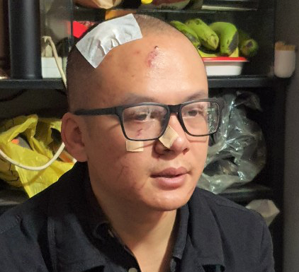 ông Nguyên nhập viện trong tình trạng chấn thương phần mềm.