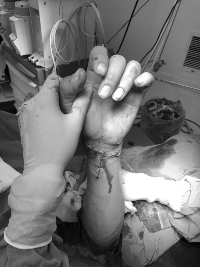  Cánh tay được nối lại thành công sau khi bị chém đứt lìa.