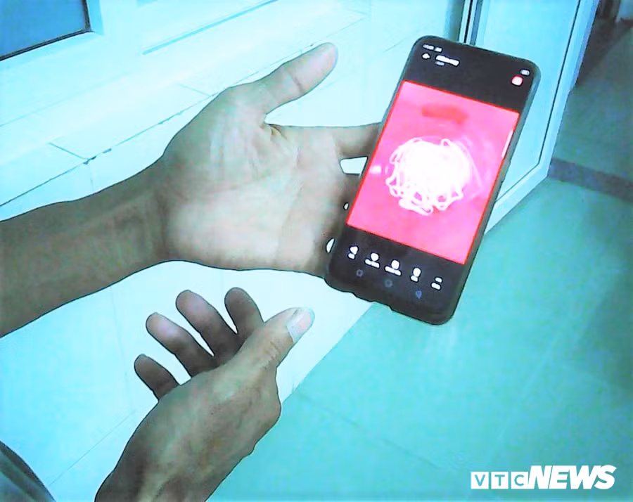 Con sán xơ mít dài 9m được chụp lại sau khi xổ ra ngoài thành công. (Ảnh: B.T) 