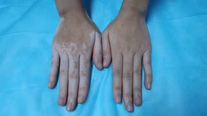 Tay phải của cô gái cũng bị giảm sắc tố. Ảnh: BSCC.