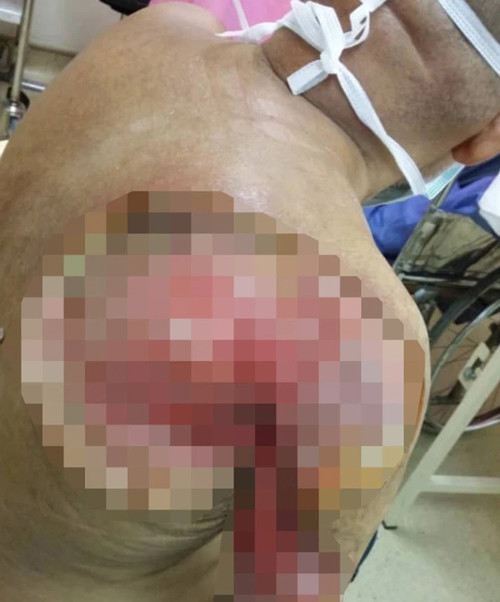 Cánh tay người đàn ông hoại tử nghiêm trọng Cánh tay người đàn ông hoại tử nghiêm trọng