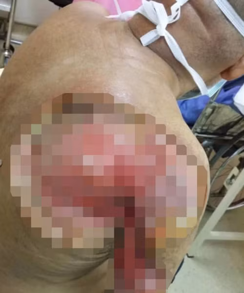 Cánh tay người đàn ông hoại tử nghiêm trọng Cánh tay người đàn ông hoại tử nghiêm trọng