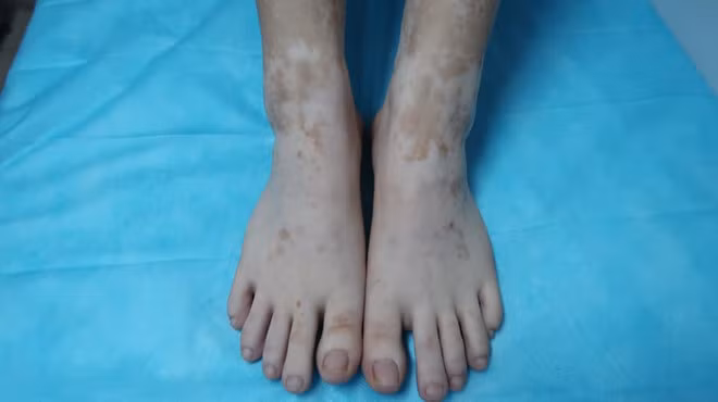  Hai chân của nữ bệnh nhân sau khi ngâm trong nước lá trầu không. Ảnh: BSCC.