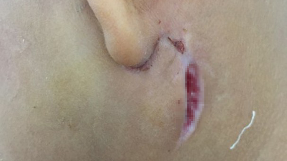 Biểu hiện bên ngoài của bệnh Whitmore của một bệnh nhân nhi đang điều trị tại Bệnh viện Sản nhi Nghệ An Biểu hiện bên ngoài của bệnh Whitmore của một bệnh nhân nhi đang điều trị tại Bệnh viện Sản nhi Nghệ An