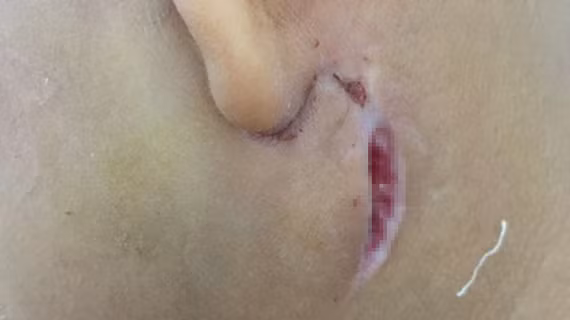 Biểu hiện bên ngoài của bệnh Whitmore của một bệnh nhân nhi đang điều trị tại Bệnh viện Sản nhi Nghệ An