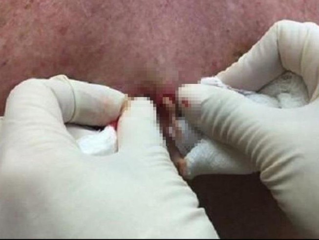 Nặn mụn nhọt dễ có nguy cơ dẫn đến nhiễm trùng huyết. Ảnh: BV CUNG CẤP Nặn mụn nhọt dễ có nguy cơ dẫn đến nhiễm trùng huyết. Ảnh: BV CUNG CẤP