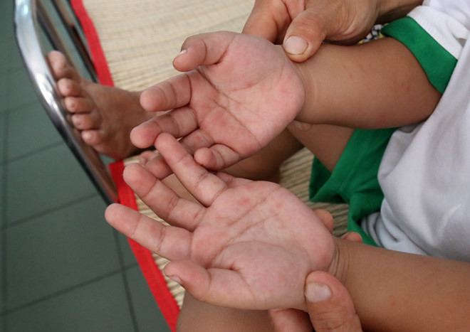 Phụ huynh cần chú ý phòng ngừa và phát hiện sớm các dấu hiệu trẻ bệnh tay chân miệng để khám và điều trị kịp thời - Ảnh: Nguyên Mi