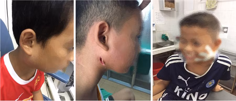  3 em nhỏ mắc bệnh Whitmore điều trị tại BV Sản Nhi Nghệ An