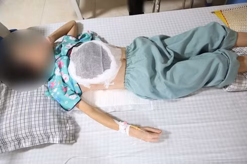  Nữ bệnh nhân nhập viện trong tình trạng nhiễm trùng, nhiễm độc do khối u vú hoại tử.