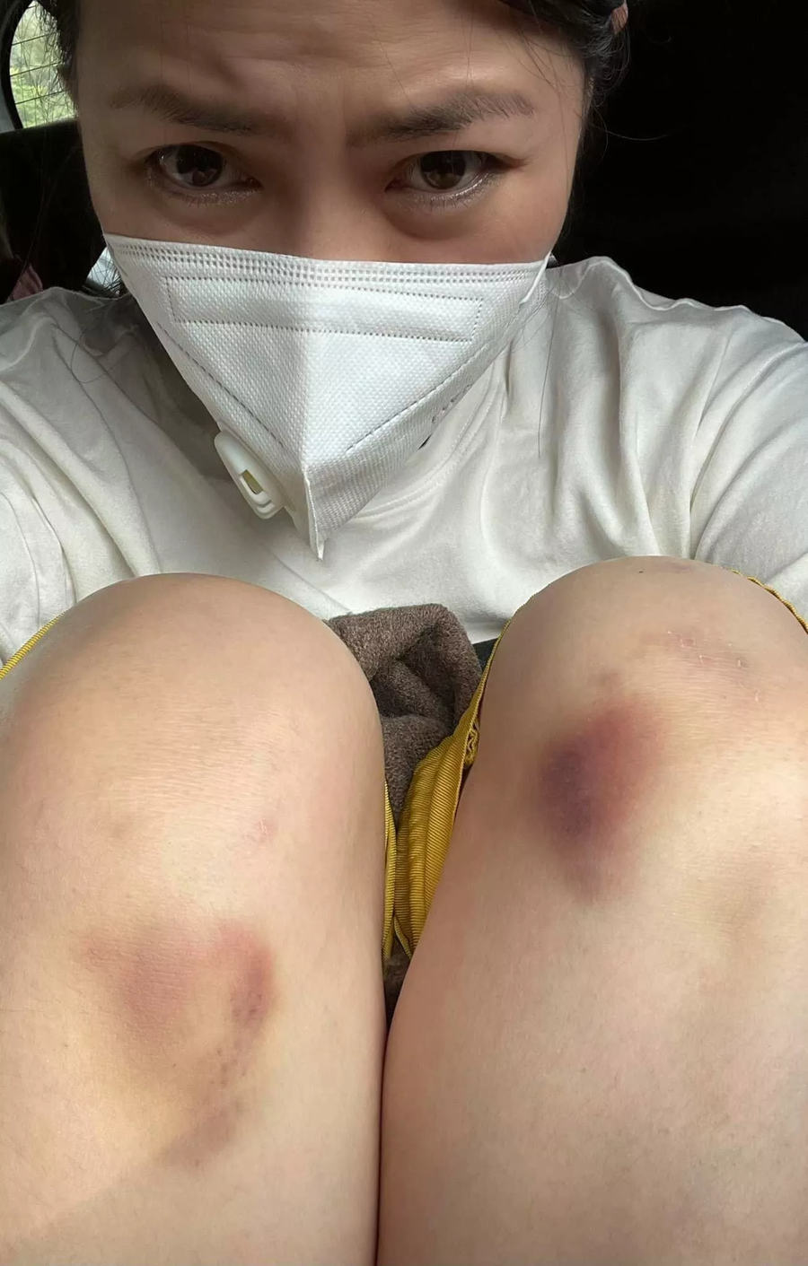 Diễn viên Ngọc Lan bầm dập sau chuỗi ngày ghi hình căng thẳng. Ảnh: FBNV